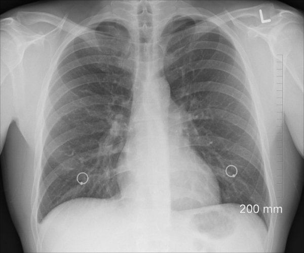 V Česku se výrazně zvýšil počet zaznamenaných případů tuberkulózy